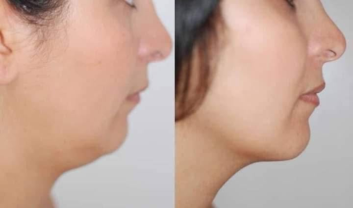 AVAJAR Perfect V Lifting Premium Plus
Mask ماسك الذقن متعدد الاستخدام